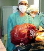 largest-tumor.jpg